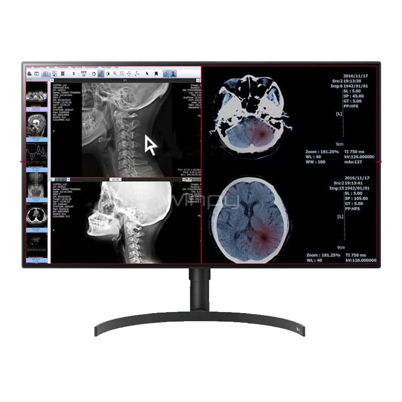 Monitor de Diagnóstico LG de 32“ (IPS, PBP / Controlador Dual, HDMI)